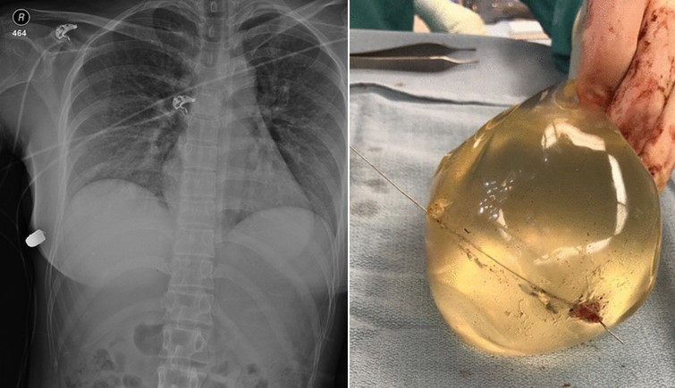 Woman's Breast Implant Deflects Bullet, Saving Her Life