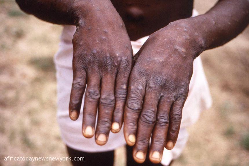 Monkeypox Detected In Australia As Authorities Raise Awareness