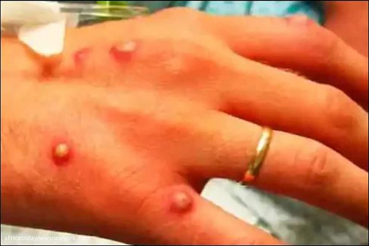 First Monkeypox Case Reported In Switzerland