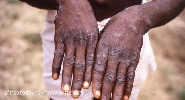 Anxiety As Kwara Confirms First Case Of Monkeypox