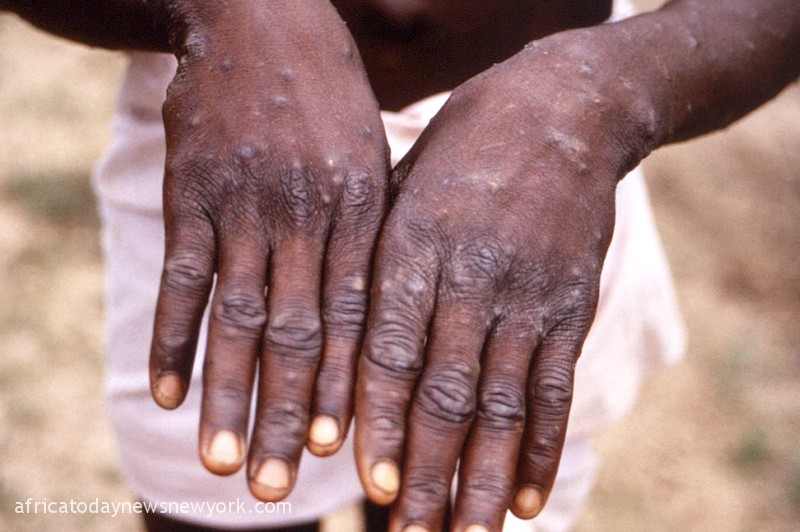Monkey Pox NCDC Confirms 10 Additional Cases In 6 States