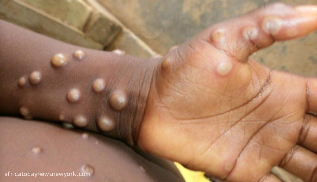 NCDC Reports Monkeypox Exposure In 15 Nigerian States