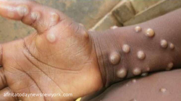 Racism WHO Set To Rename Monkeypox As ‘Mpox’