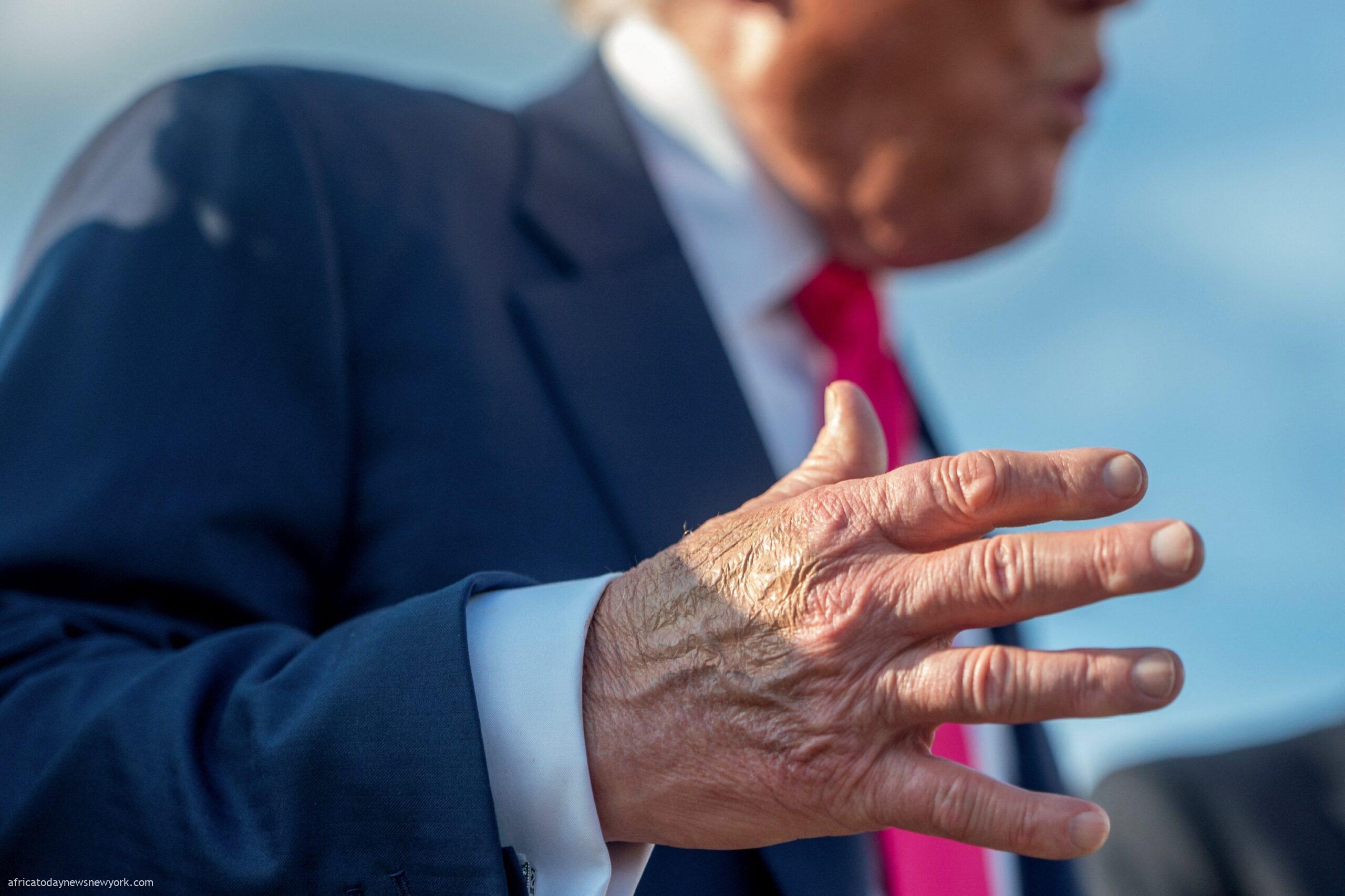 Trump’s Swollen Leg, Bruised Hand Linked To Vein Complication