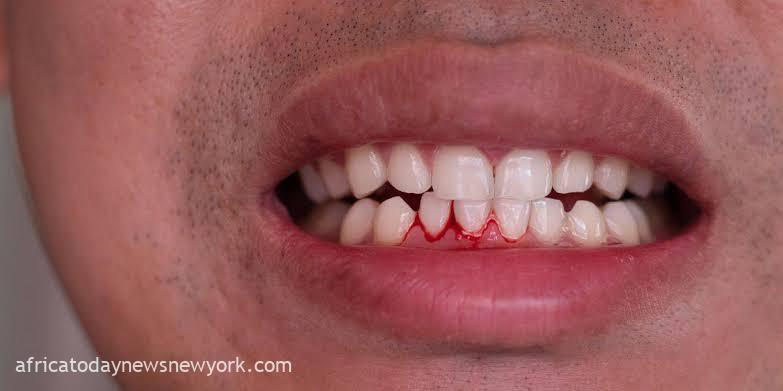 Bleeding Gums Led Student To Rare Blood Cancer Diagnosis